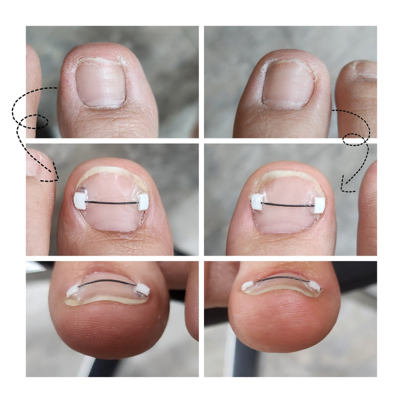 CORRECTOR - INGROWN NAIL TREATMENT