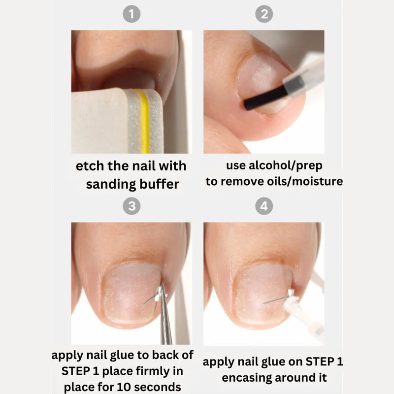 CORRECTOR - INGROWN NAIL TREATMENT